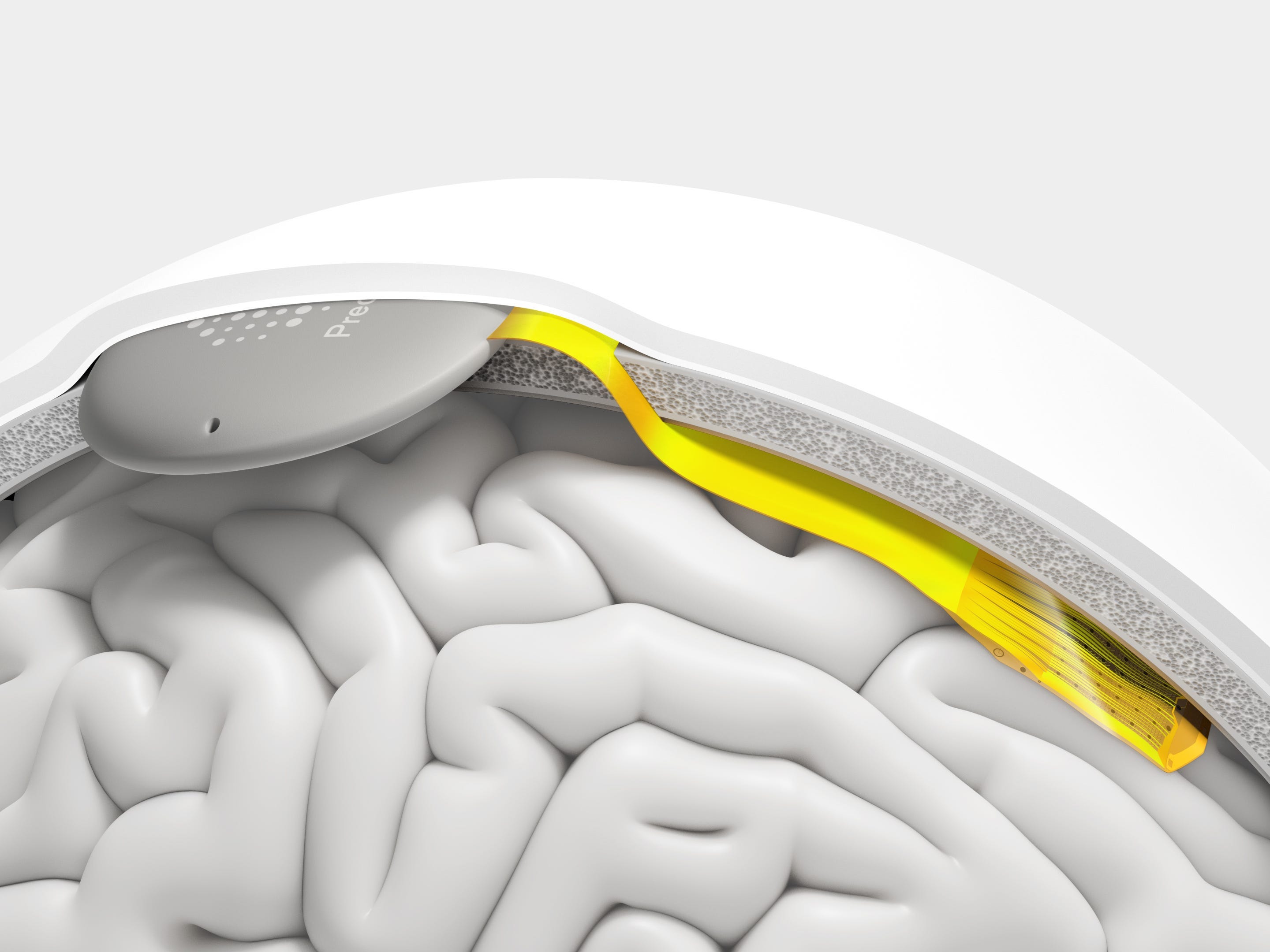 Precision Neuroscience