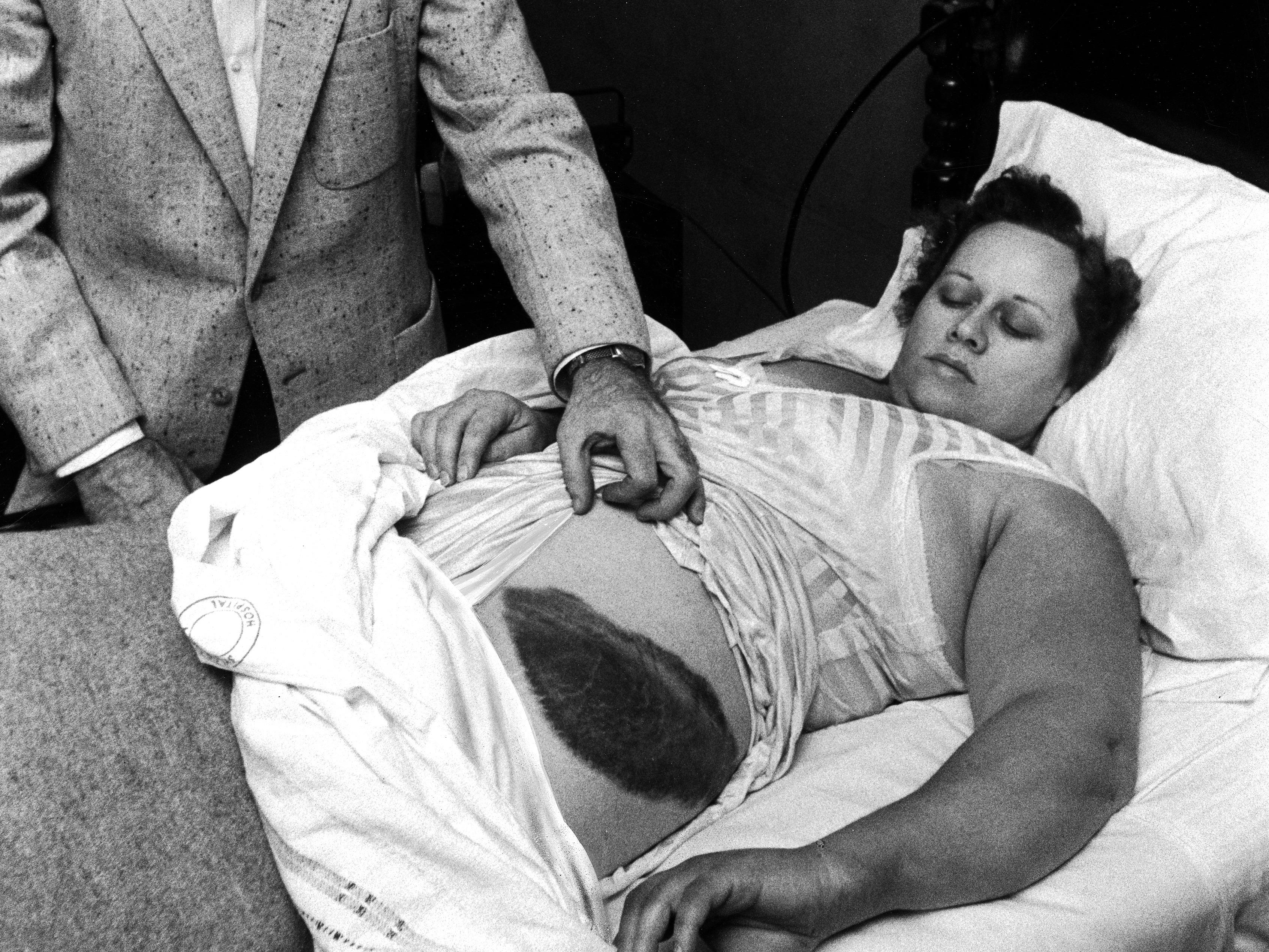 Anne Hodges after being hit by a meteorite