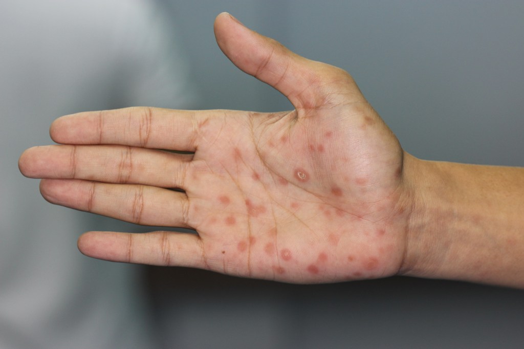 Secondary syphilis lesions on a palm.