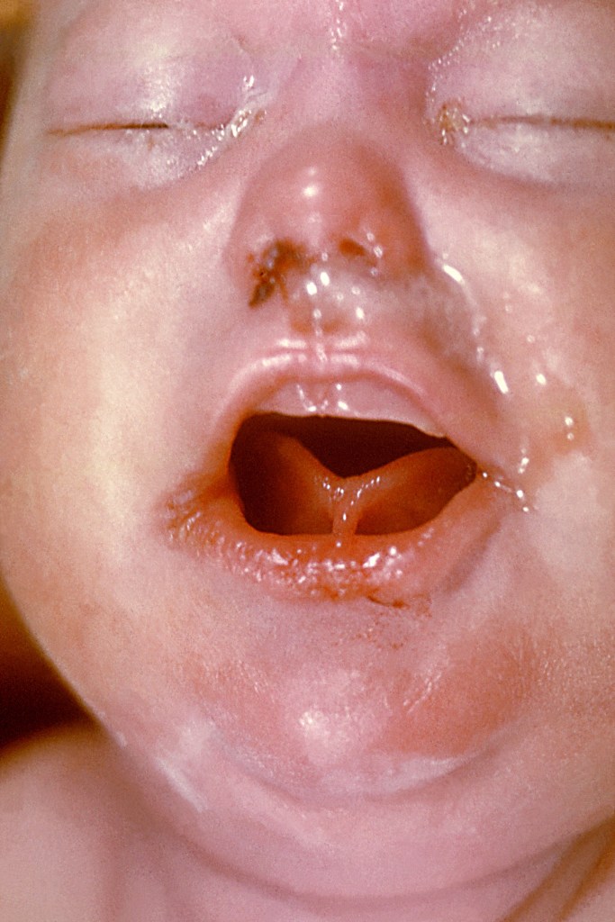 Close-up of a newborn's face showing signs of congenital syphilis.