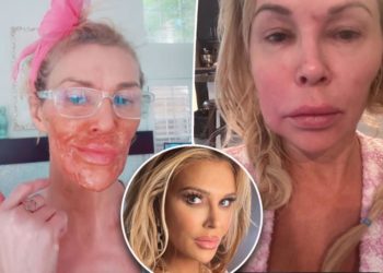 Brandi Glanville feels like ‘such a loser’ as debilitating face parasite leaves her unable to pay bills