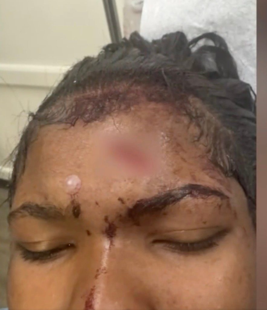 Close-up of a teenager's forehead with a large wound and blood.