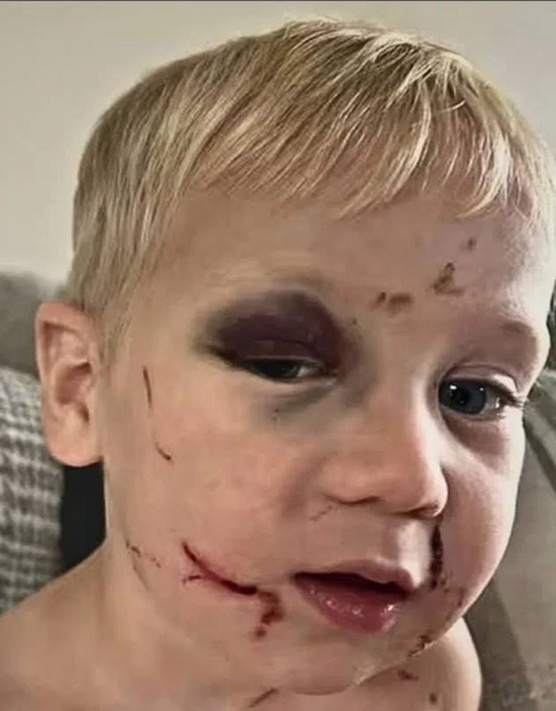 Toddler with a black eye and facial injuries.