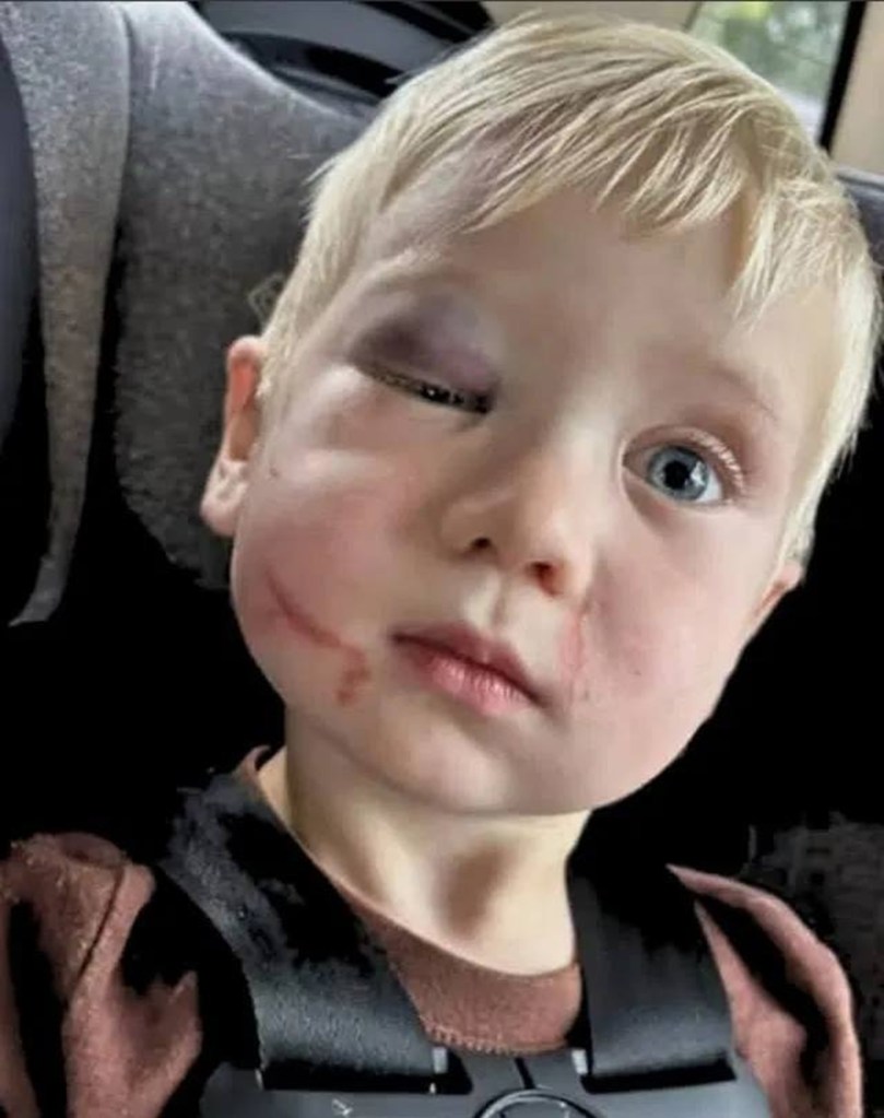Toddler with facial injuries.