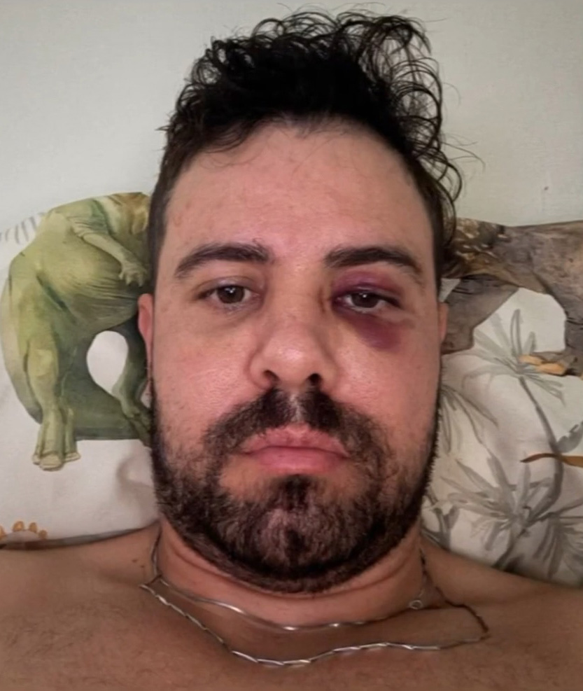 Close-up of a man with a black eye.