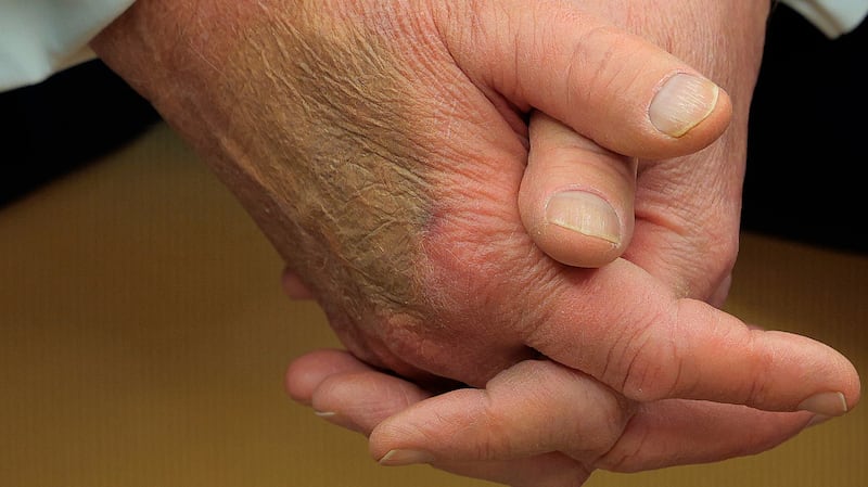 Makeup covers a bruise on the back of U.S. President Donald Trump's hand as he hosts French President Emmanuel Macron for meetings at the White House on February 24, 2025 in Washington, DC.