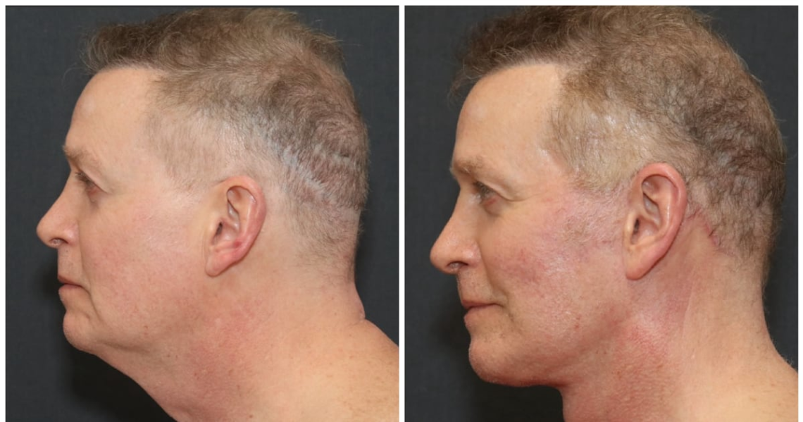 65-Year-Old Gets Dramatic ‘Leading Man’ Plastic Surgery Transformation