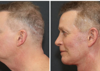 65-Year-Old Gets Dramatic ‘Leading Man’ Plastic Surgery Transformation