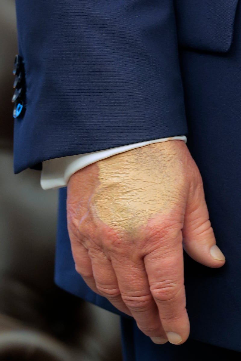 WASHINGTON, DC - AUGUST 22: A patch of discolored skin is visible on the back of U.S. President Donald Trump's hand as he talks about the FIFA World Cup in the Oval Office at the White House on August 22, 2025 in Washington, DC. Trump announced the FIFA World Cup 2026 draw will take place at The Kennedy Center. (Photo by Chip Somodevilla/Getty Images)