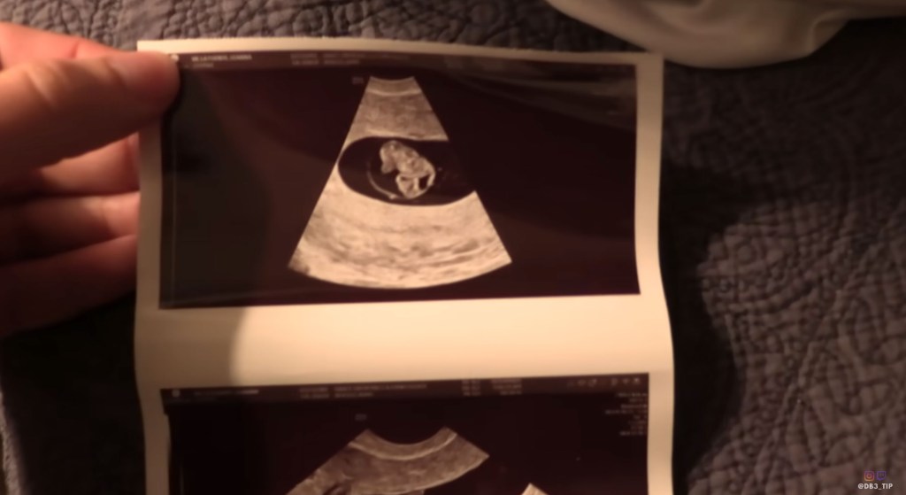 Travis Hunter and Leanna Lenee's sonogram.
