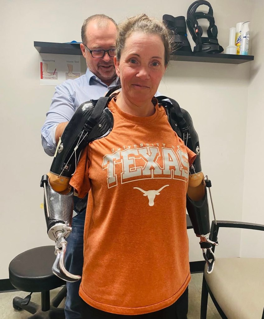Woman with bilateral body-powered prosthetic arms.