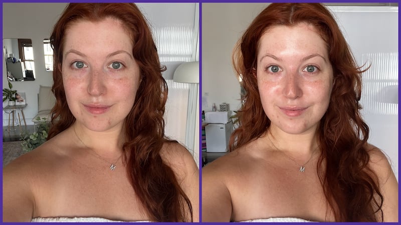 Mary Honkus before and after pictures of buccal fat removal