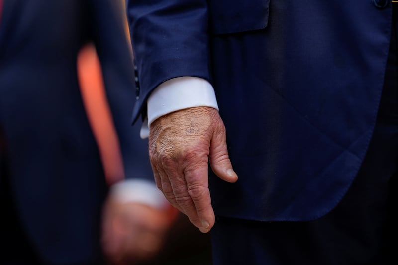 Make-up covers the back of the right hand of U.S. President Donald Trump during a tour of the Federal Reserve Board building in Washington, D.C., U.S., July 24, 2025. In a July 17, 2025 press briefing, U.S. Press Secretary Karoline Leavitt read a statement from his doctor that President Trump has a chronic venous insufficiency. REUTERS/Kent Nishimura