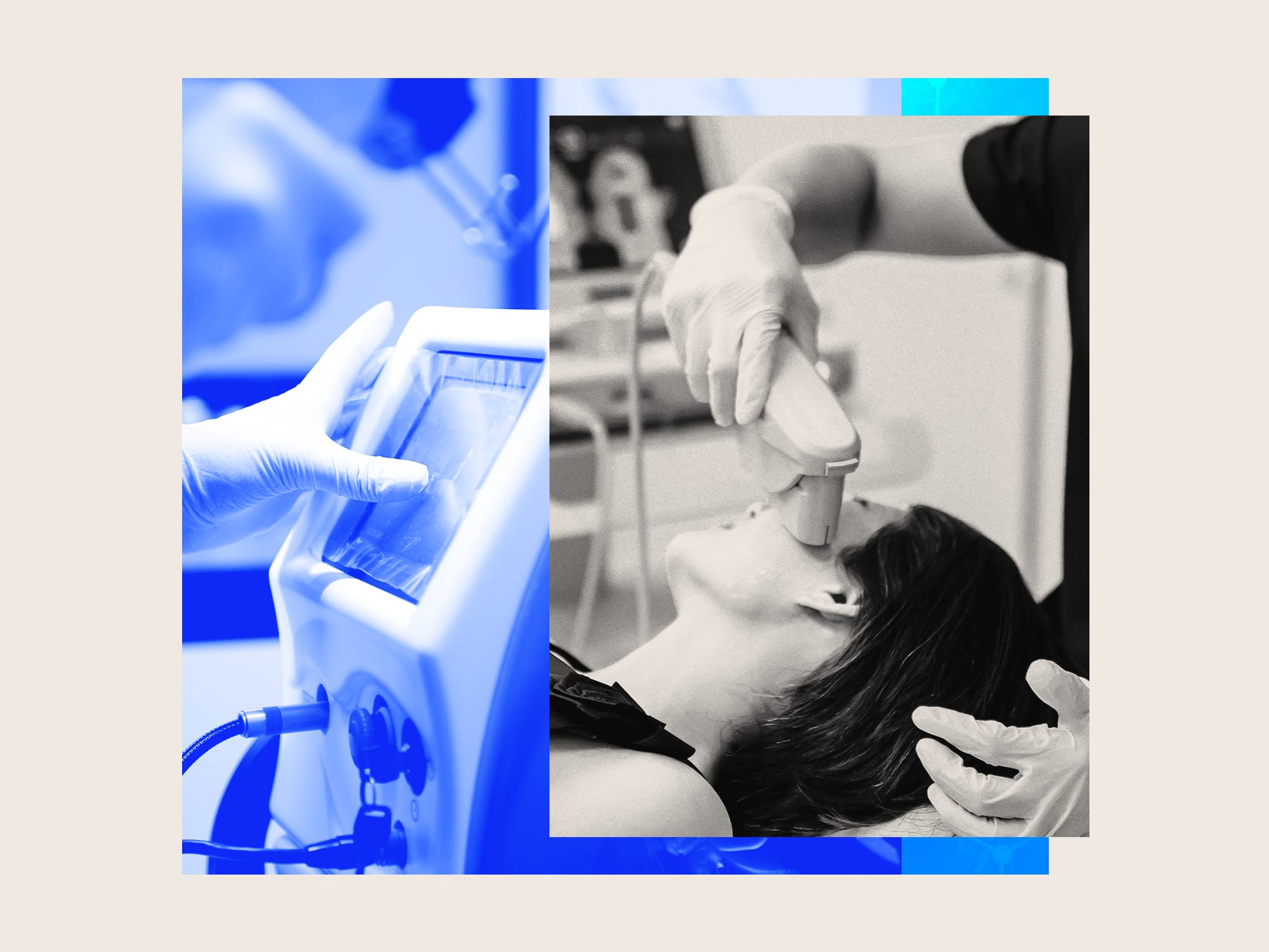 Photo collage featuring a photo of a esthetician using Ultrasound SMAS face lifting on a patient's face, laser resurfacing machine, and transforming treatment patterns.