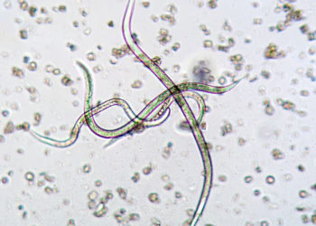 This Man’s Blurry Vision Turned Out To Be Worms Swimming in His Eyeball