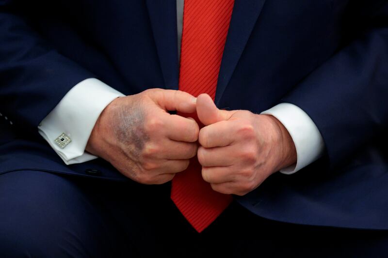 President Donald Trump tried to keep the months-old bruise on his right hand out of view Monday. The White House has put down the mark to too much handshaking.