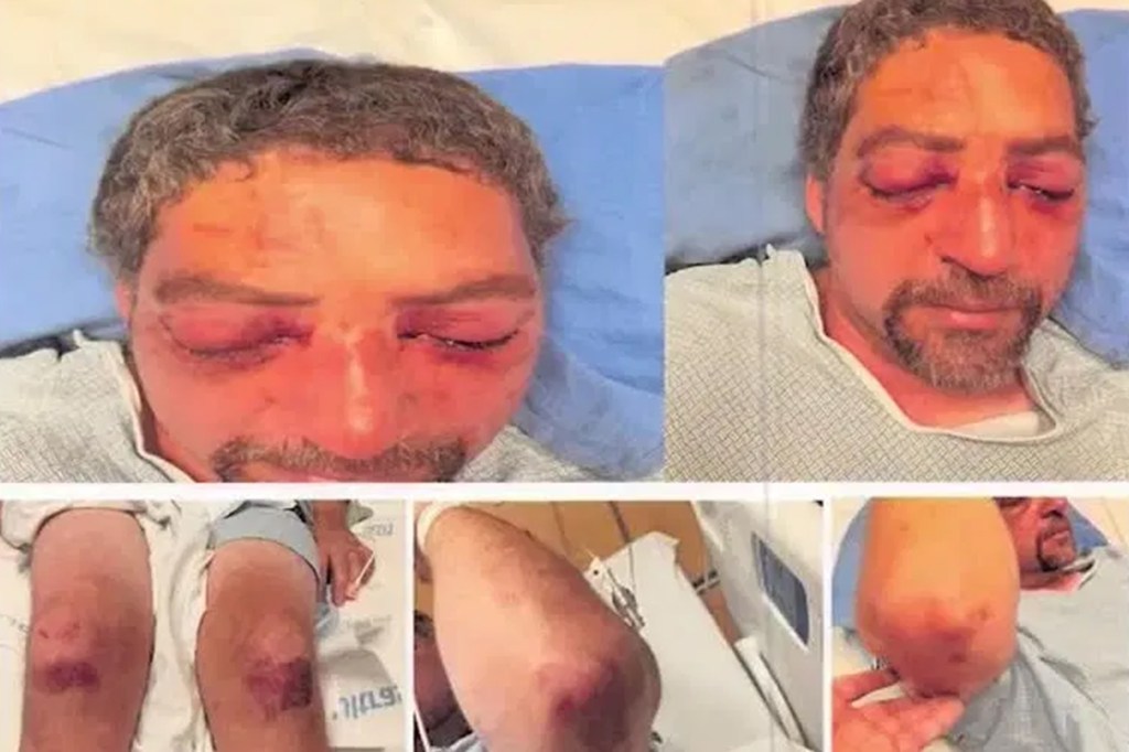 Photos of a man's severe facial and body bruising.
