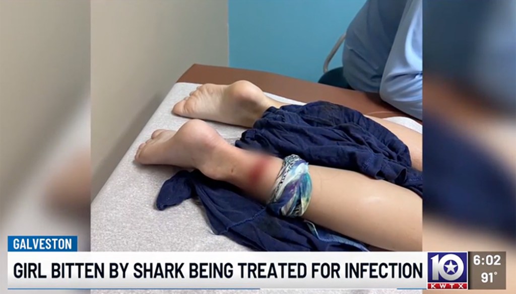 Girl's leg with shark bite being treated for infection.