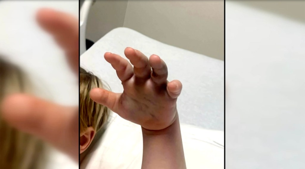 Child's hand with copperhead snake bite.