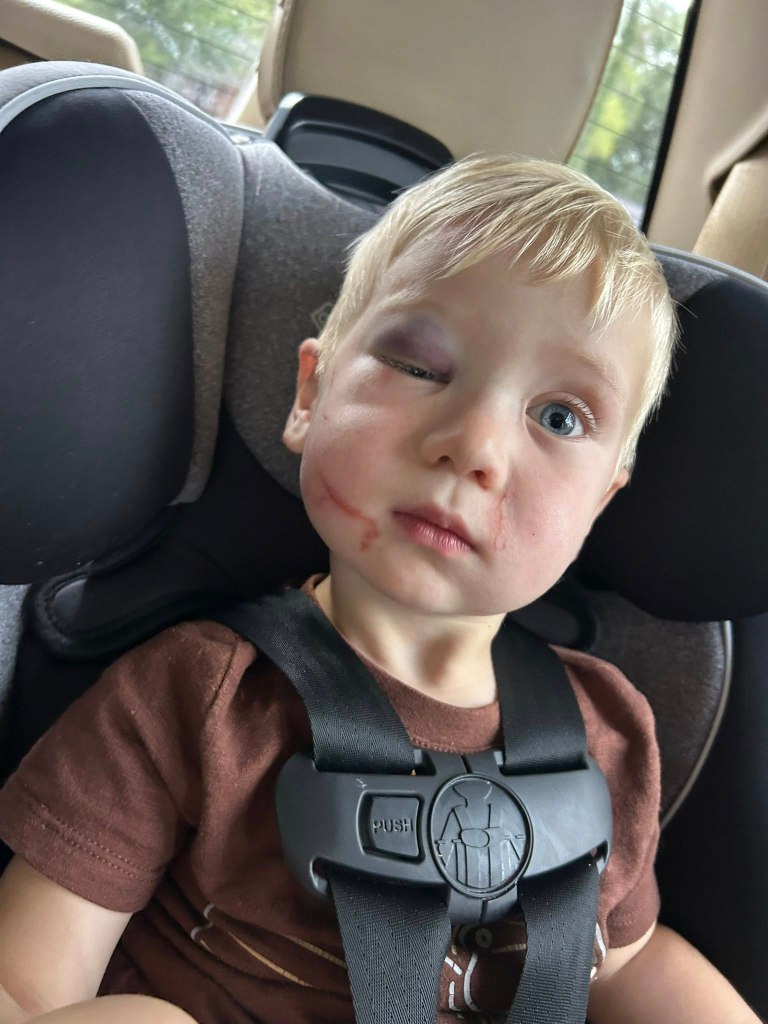 Toddler with a black eye and facial injuries in a car seat.
