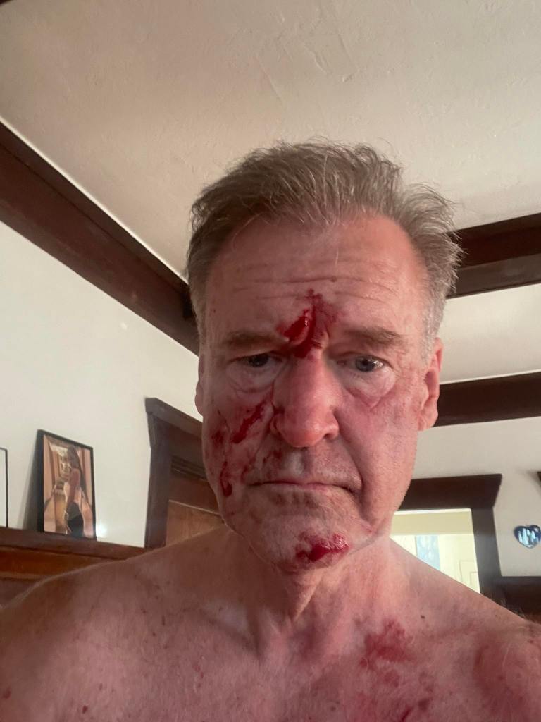 Man with bloody injuries to his face and chest.