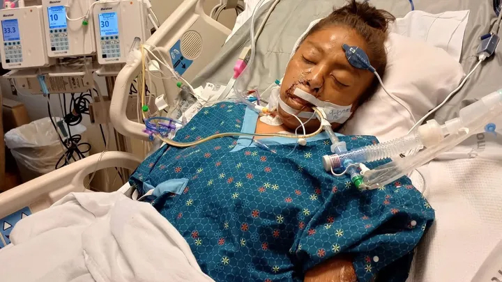 A woman lies in a hospital bed with medical tubes and wires around her face and attached to equipment.