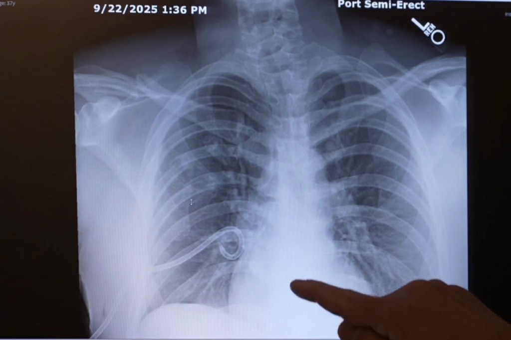 A chest X-ray displaying the heart, lungs, and rib cage, with a tube visible on the left side and a finger pointing to the heart.