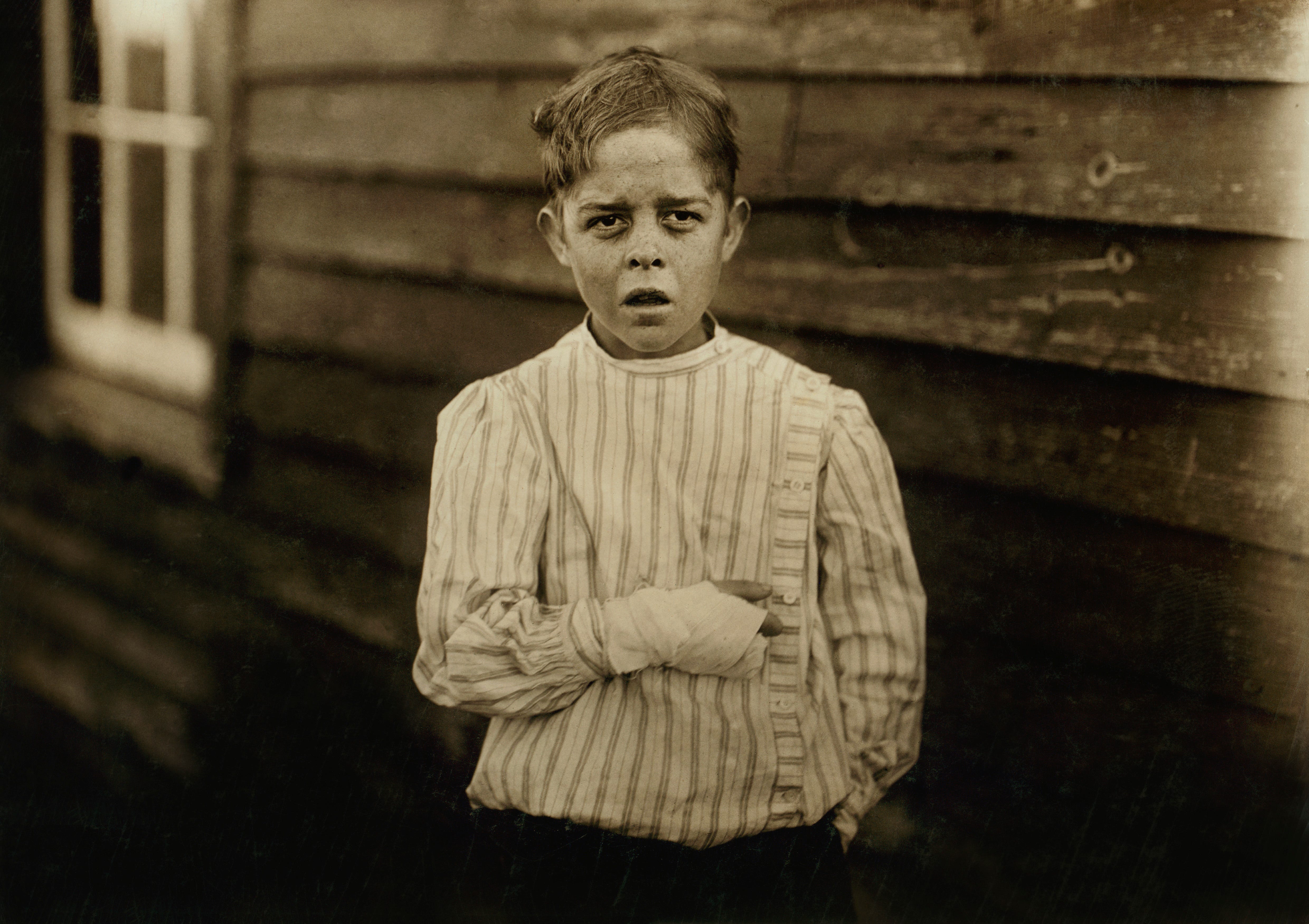 A boy in a striped shirt with a bandage around his hand, concealing missing fingers