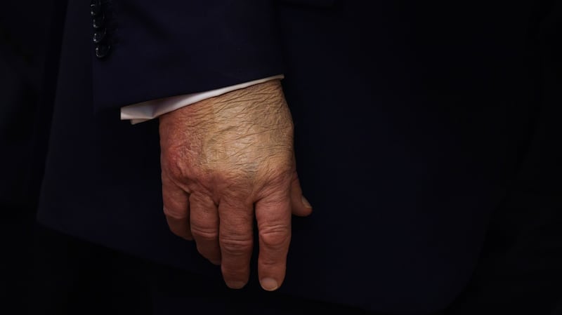 WASHINGTON, DC - SEPTEMBER 02: A detailed view of the hand of U.S. President Donald Trump as he speaks in the Oval Office at the White House on September 2, 2025 in Washington, DC. Following days of speculation about his health from users on social media, President Trump made his first public appearance in a week to announce the moving of Space Command headquarters from Colorado to Alabama.