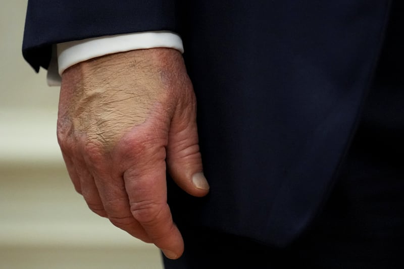 President Donald Trump's right hand is seen covered in makeup on the day he announced a deal with Pfizer to sell drugs at lower prices.