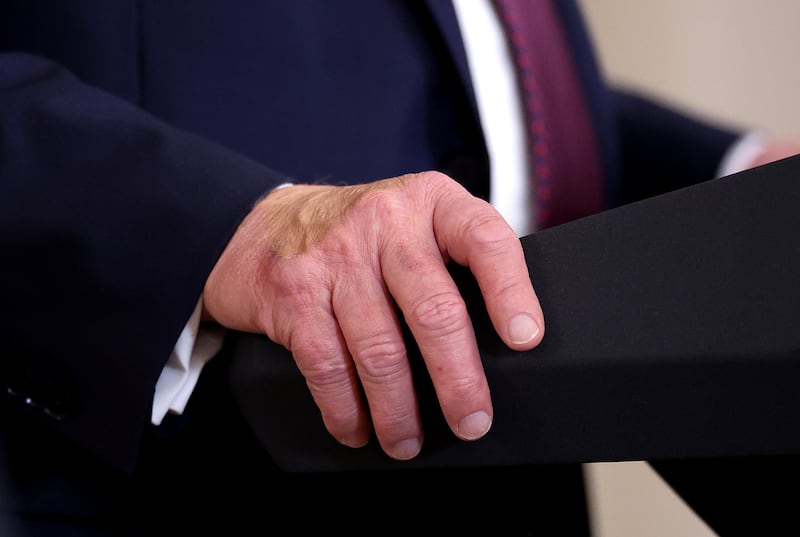 President Donald Trump's right hand was seen caked in makeup as he held a joint presser with Israeli Prime Minister Benjamin Netanyahu on Monday.