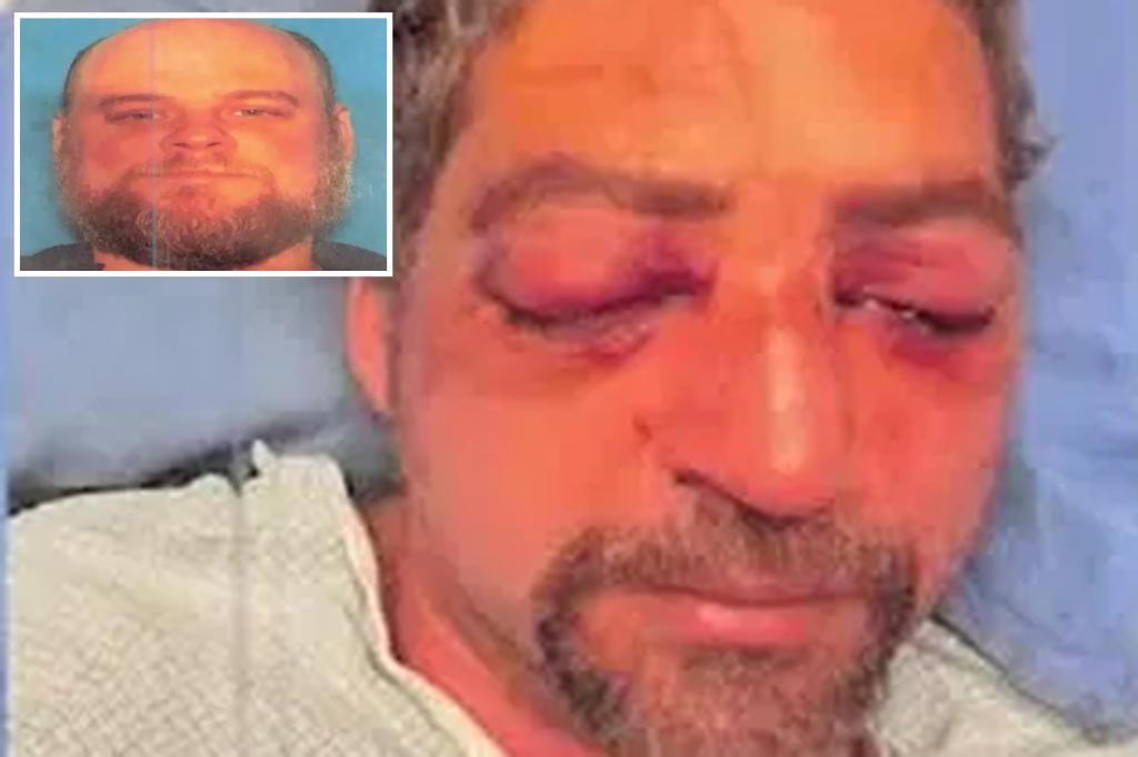 Vermont husband almost permanently blinded after road rage maniac gouged his eyes during brutal assault