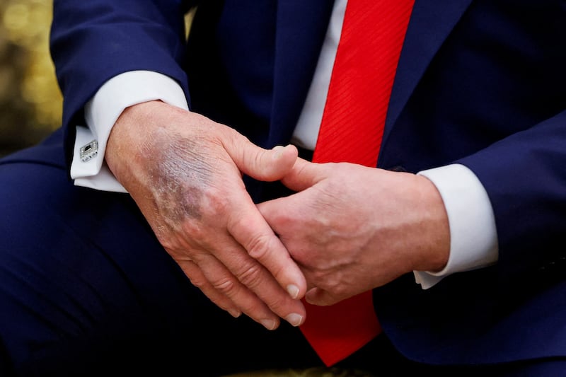 The White House says Trump's bruise is from frequent handshaking and using aspirin.