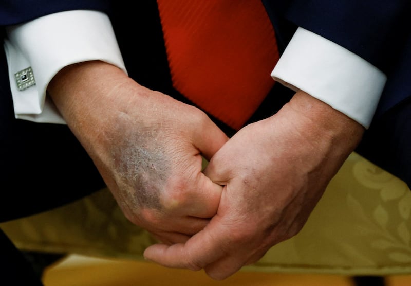 Trump's bruised right hand is visible during a meeting with South Korean President Lee Jae Myung in the Oval Office last month.