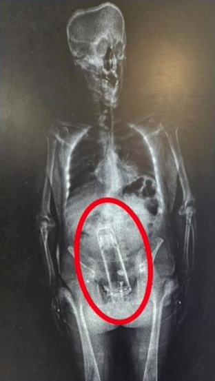 X-ray of a human torso with a thermos lodged in the rectum.