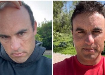 World Cup Star Posts Dramatic Before-and-After of Hairpiece Installation
