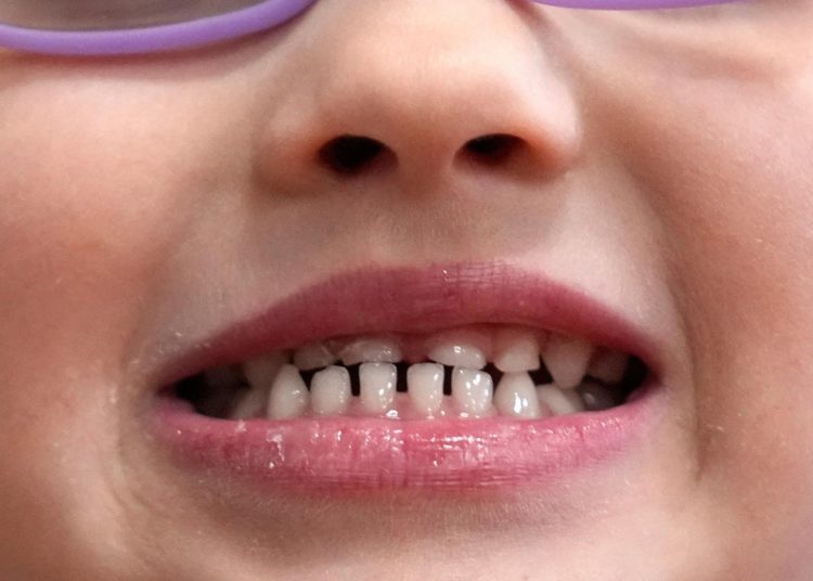 FDA restricts use of kids’ fluoride supplements, citing emerging health risks