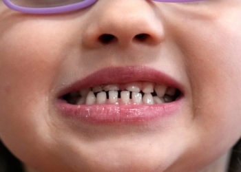 FDA restricts use of kids’ fluoride supplements citing emerging health risks