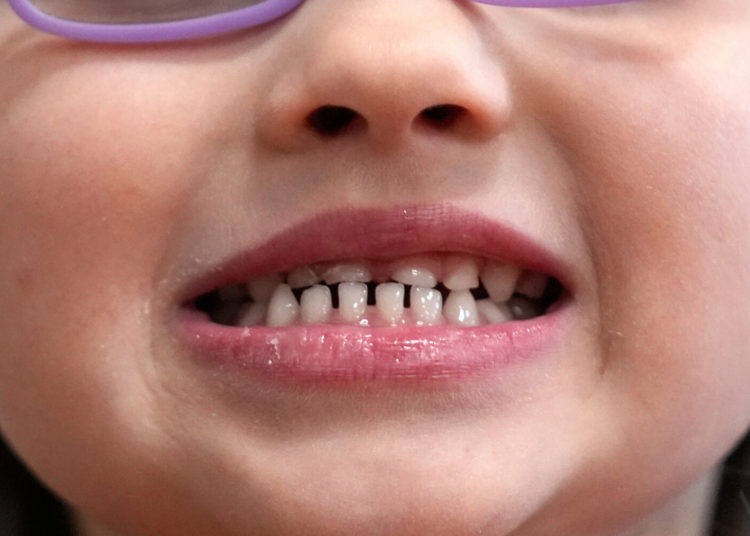 FDA restricts use of kids’ fluoride supplements citing emerging health risks