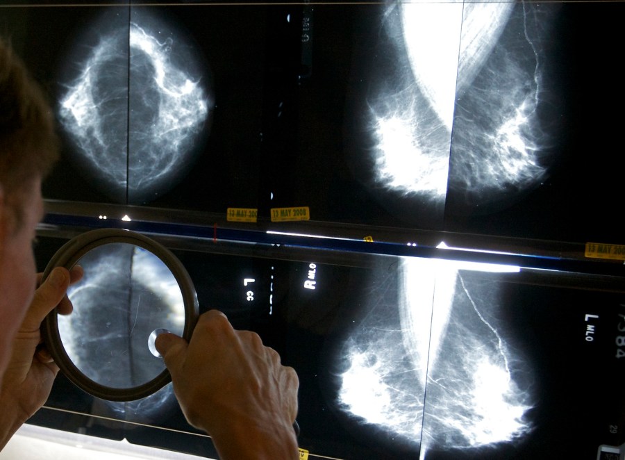 “I didn’t know that men could get breast cancer:” survivor shares cancer experience