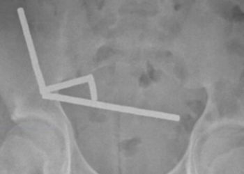 Teen Loses Part of Intestine After Swallowing 200 Magnets