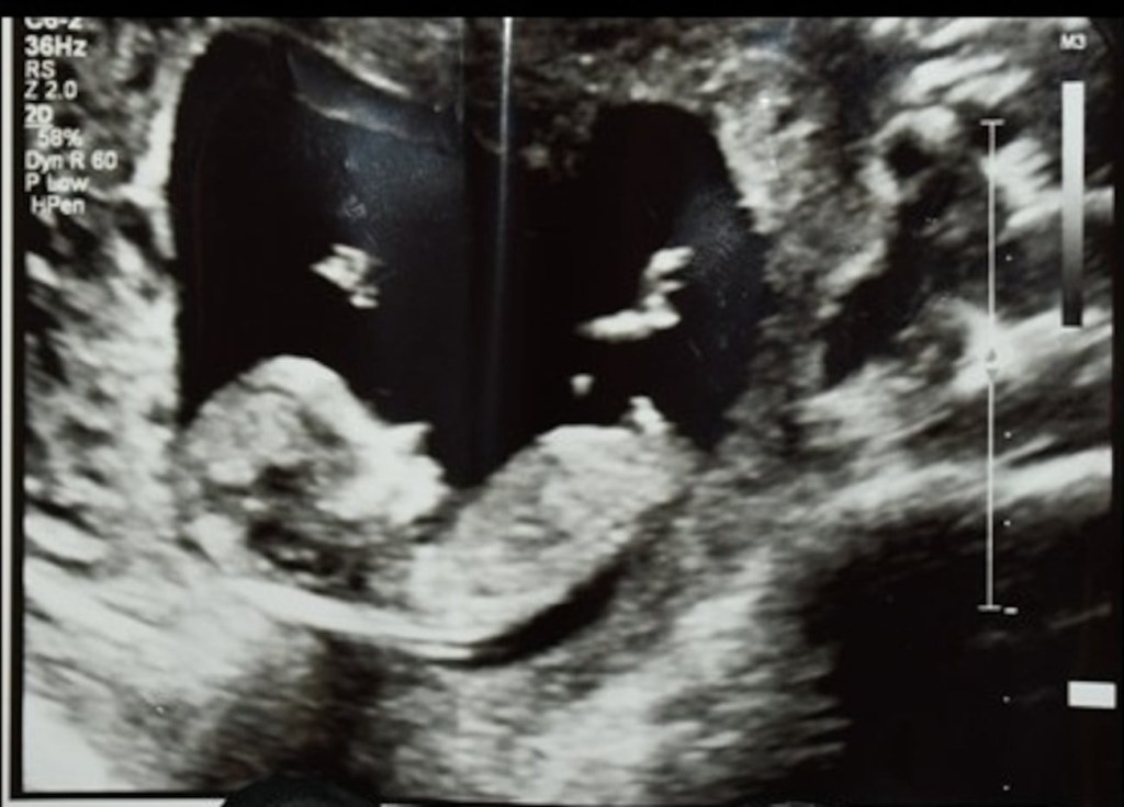 An ultrasound photo was found near her body, police said.