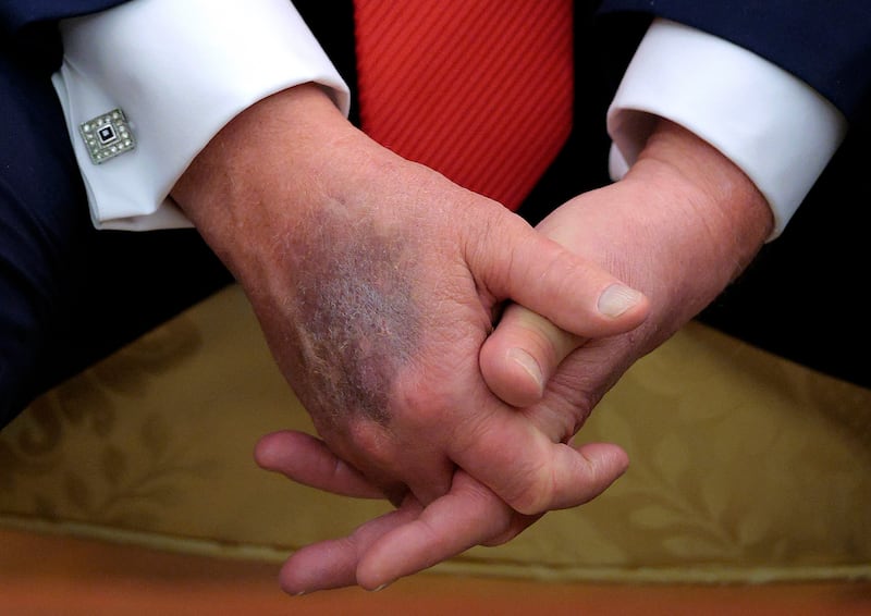 WASHINGTON, DC - AUGUST 25: A bruise is visible on the back of U.S. President Donald Trump's right hand during a meeting with  South Korean President Lee Jae-myung in the Oval Office at the White House on August 25, 2025 in Washington, DC. White House Press Secretary Karoline Leavitt was asked about the bruising in February and she responded, "President Trump has bruises on his hand because he’s constantly working and shaking hands all day every day." (Photo by Chip Somodevilla/Getty Images)