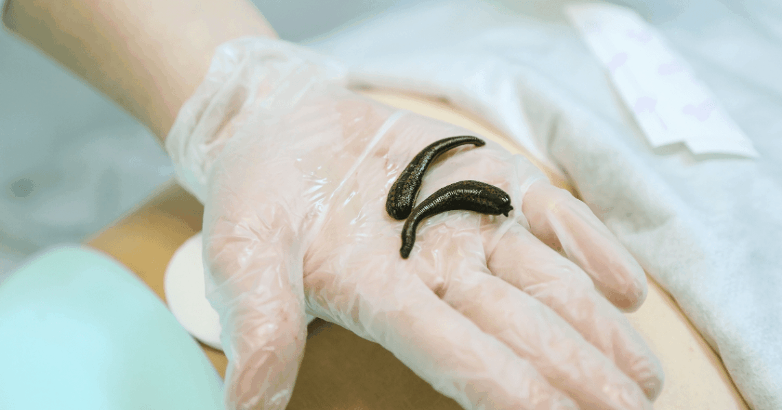 Doctors Cured Man’s Chronic Nosebleeds by Pulling a Leech Out of His Nose