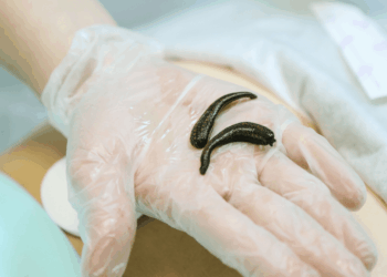 Doctors Cured Man’s Chronic Nosebleeds by Pulling a Leech Out of His Nose