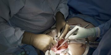 First clinical trial of pig kidney transplants gets underway