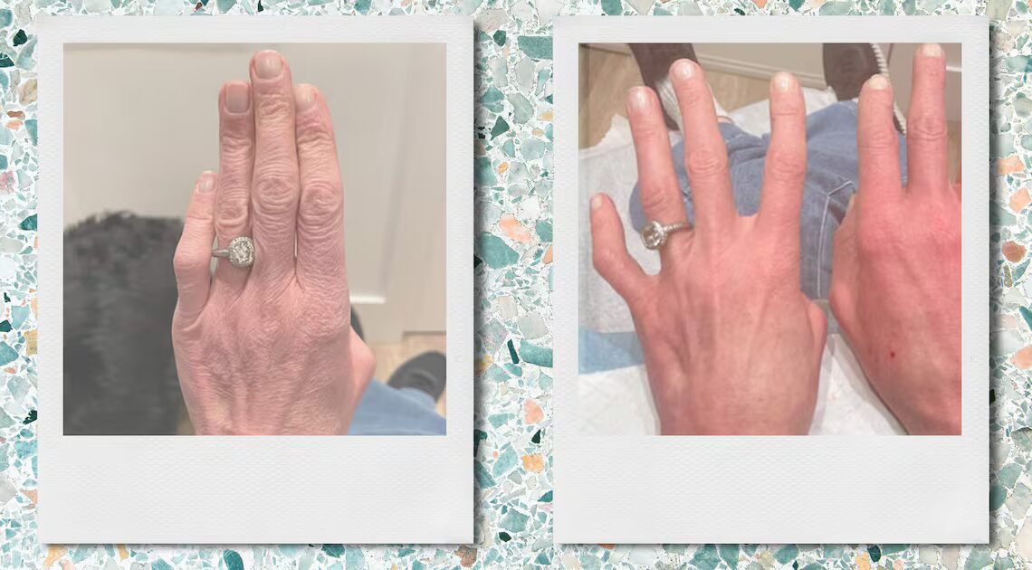 This Treatment Made My Hands Look 20 Years Younger in One Appointment
