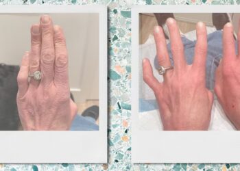 This Treatment Made My Hands Look 20 Years Younger in One Appointment