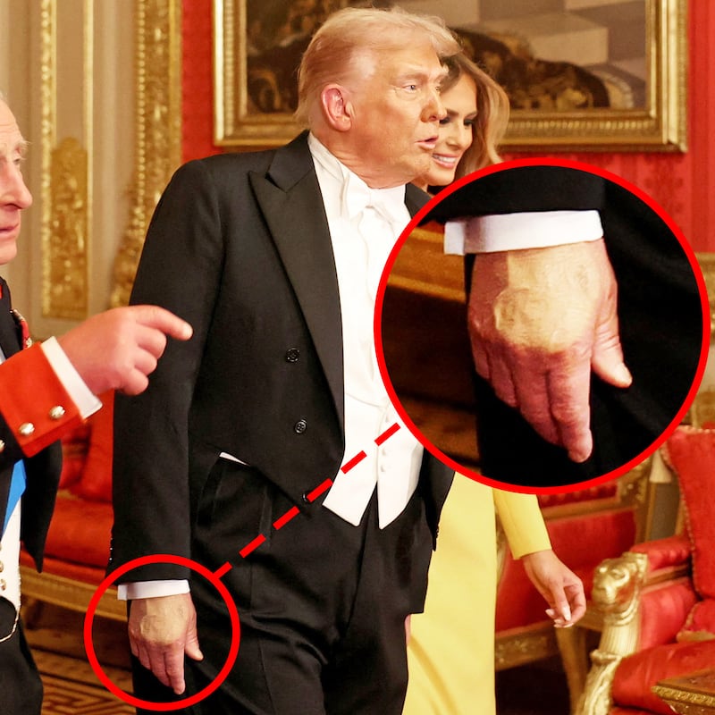 Red circle around Trump's hand makeup. Britain's King Charles, U.S. President Donald Trump and first lady Melania Trump walk to attend the State Banquet during U.S. President Donald Trump's state visit, at Windsor Castle, in Windsor, Britain, September 17, 2025.