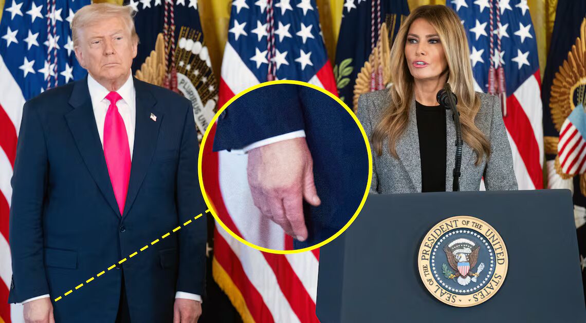 Trump, 79, Wears Hand Makeup for Melania Speech